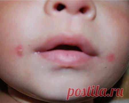 Народные средства лечения стрептодермии 
Стрептодермия (пиодермия стрептококковая) – кожное инфекционное заболевание, вызываемое патогенными стрептококками, поражающими поверхностный слой кожи, не затрагивающими сальные и потовые железы. Оч…