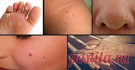 Главврач: «Наличие висячих папиллом на шее и в подмышках означают признак ранней… Чтобы убрать, надо!»