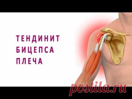 Тендинит бицепса плеча