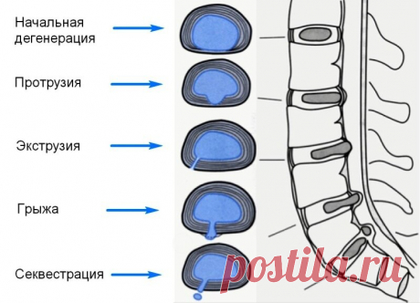 Грыжи межпозвонковых дисков. Когда лечим, а когда оперируем. | Невролог Татьяна Ершова | Дзен