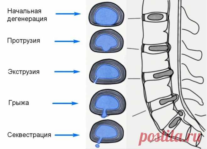 Грыжи межпозвонковых дисков. Когда лечим, а когда оперируем. | Невролог Татьяна Ершова | Дзен