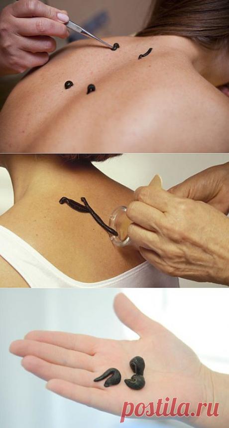 Гирудотерапия, лечение с помощью пиявок. Часть 2 | Самые популярные и самые вкусные рецепты с видео