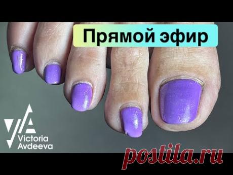 Подногтевые мозоли. Скрученная ногтевая пластина. Педикюр. Виктория Авдеева