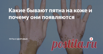 Какие бывают пятна на коже и почему они появляются Пятна на коже являются более распространенным типом проблемы, чем кажется. Они происходят из-за изменения пигментации, хотя причины могут быть очень разнообразными. Эти пятна могут появляться в виде родинок, веснушек или пятен с течением времени (из-за старения).
Прямое воздействие определенных факторов окружающей среды может также привести к пятнам или усугубить их. Самый агрессивный агент для на