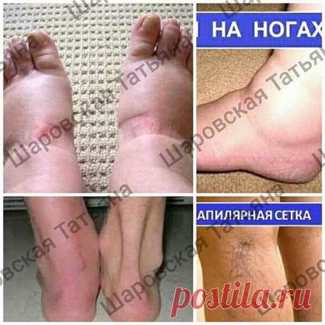 #ноги #отечность #варикоз Два месяца и ваши ножки, как у горной лани.