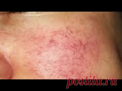 КУПЕРОЗ. Чем чистить лицо при куперозе дома?