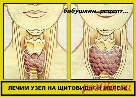 ЛЕЧИМ УЗЕЛ НА ЩИТОВИДНОЙ ЖЕЛЕЗЕ
Смешайте по одному стакану молотой гречневой крупы, пропущенных через мясорубку грецких орехов и меда в эмалированной (абсолютно чистой) посуде и переложите в стеклянную банку. 
Один раз в неделю за целый день съешьте этот состав, не принимая больше никакой пищи, кроме воды. 
Сделайте так шесть раз, т. е. шесть недель. 
Затем через месяц повторите лечение.