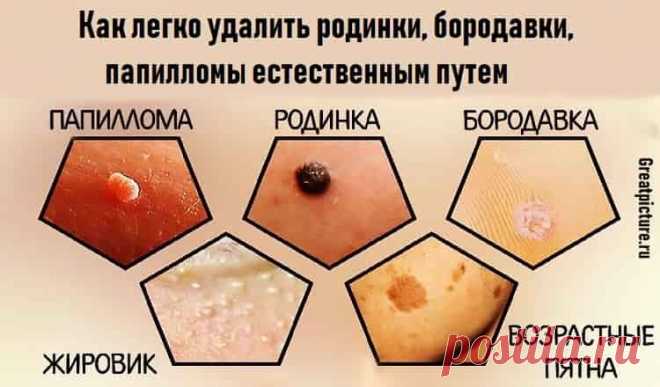 Как легко удалить родинки, бородавки, папилломы естественным путем 
 Как легко удалить родинки, бородавки, папилломы естественным путем.
Молодая вы или пожилая, в какой-то момент мы все сталкиваемся с проблемами кожи, которые сбивают нас с толку. Может быть, это из-з…
