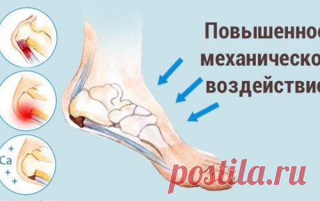 Пяточная шпора: самое эффективное средство для снятия воспаления и боли!