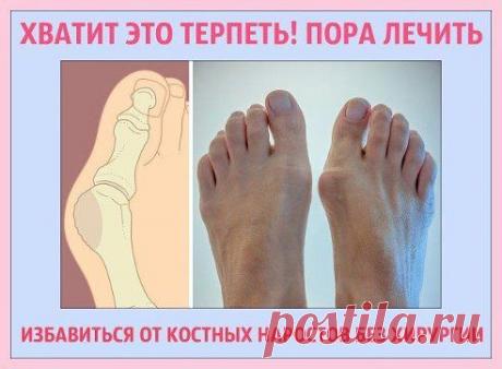 ЭФФЕКТИВНЫЙ СПОСОБ БЫСТРО УБРАТЬ КОСТОЧКИ НА НОГАХ

Косточки на ногах, или вальгусное отклонение большого пальца стопы, или, другими словами, костные наросты не обязательно лечить хирургическими методами. Пока деформация костей еще не приобрела угрожающего характера, можно применить современные нехирургические методы воздействия на больные суставы. Какие же? 
Продолжение читай тут — ok.ru/zapiskily
•••