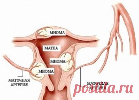 Лечение миомы травами. Травы от миомы матки.