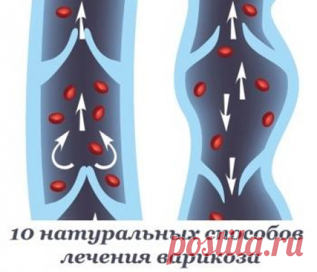 10 натуральных способов лечения варикоза