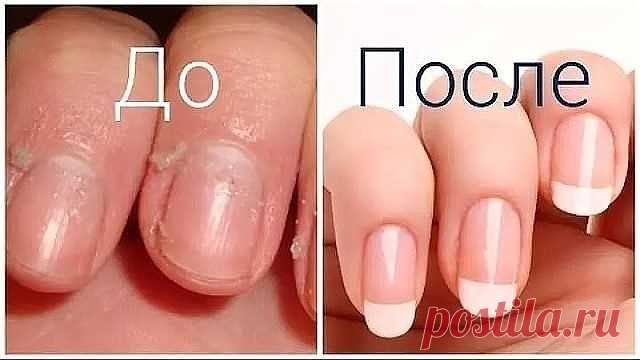НОГТИ СТАНУТ БЕЛЫМИ И КРЕПКИМИ! Чтобы ногти всегда выглядели ухоженными и были белыми, длинными и крепкими советую этот рецепт! Сама им пользуюсь, результат поражает! Для этого нужно приготовить пасту, берем чайную ложку…Продолжение- Для крепких и белых ногтей приготовьте пасту из: (все по пол чайной ложки) — тертый картофель — зубная паста — перекись водорода — сода Нанести на ногти на […]