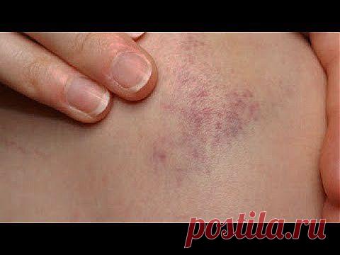 Подорожник – от ушибов помощник | Друг пенсионера
Мне уже давно за 40, но я люблю вместе с детьми поездить на вело­сипедах. Например, куда-нибудь в поход на велосипеде отправиться. Это же милое дело! Но вот однажды как раз в таком походе случилась до­вольно неприятная история. Мы ус­пели отъехать от дома километров десять, когда в цепь своего «двухко­лесного друга» я умудрилась закру­тить штанину.