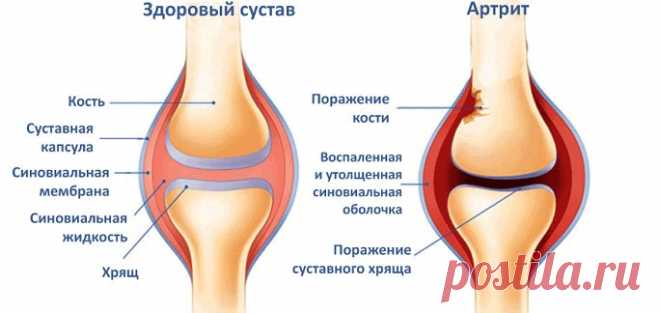 Болезни суставов и их лечение народными средствами.