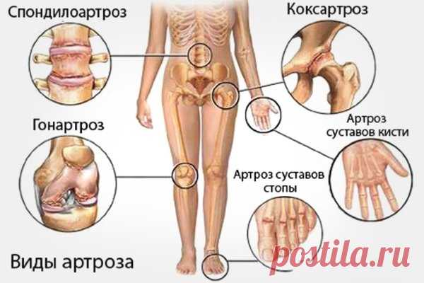 Что такое артроз: его виды, симптомы и методы его лечения