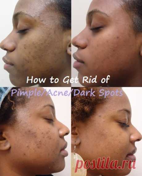 How to Get Rid of Black Scars &amp; Marks on Face | Virtual Clinic