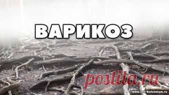 Что такое варикозное расширение вен и что должен знать каждый о нём? | Net-Bolezniam.Ru | Яндекс Дзен