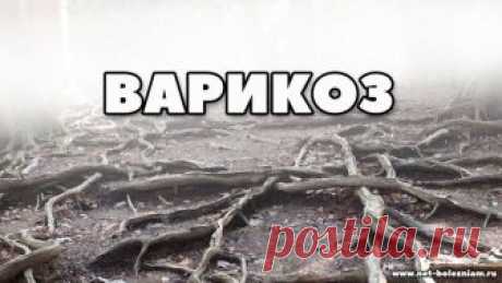 Что такое варикозное расширение вен и что должен знать каждый о нём? | Net-Bolezniam.Ru | Яндекс Дзен