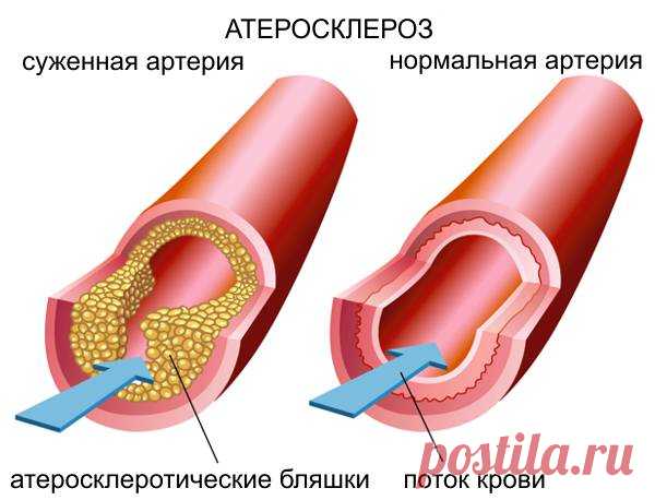 Продукты которые очищают сосуды и помогают избавиться от атеросклероза