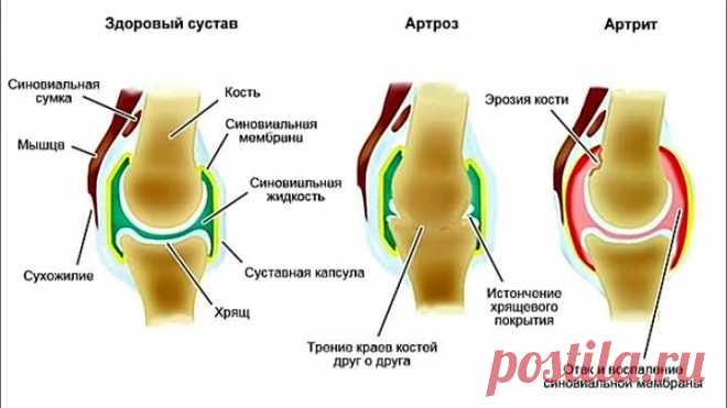 Как я вылечил артрит, артроз - Отзывы