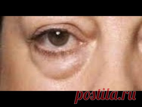 Аптечные средства ОТ МЕШКОВ ПОД ГЛАЗАМИ. - YouTube