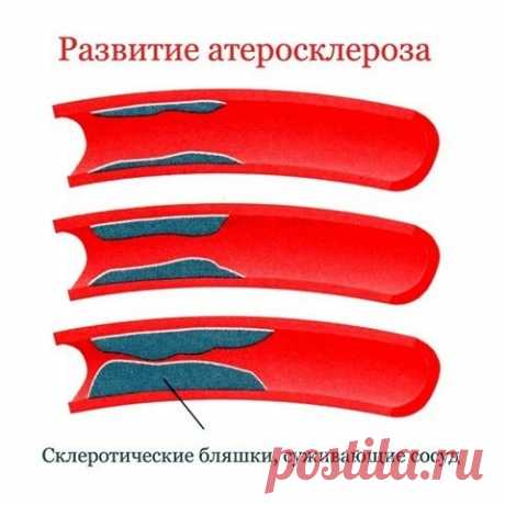Проверенные поколениями народные средства для сосудов.

1. Сосна и шиповник.

- Возьмите сосновые веточки, измельчите иголки при помощи ножниц.
Показать полностью…