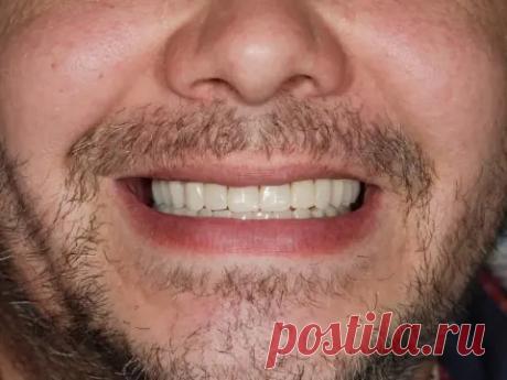 Несъемное протезирование верхней челюсти на 6 имплантах в стоматологии АлексДент