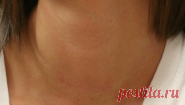 Йод: жизненно важный минерал, который успешно лечит рак молочной железы!
Йод — минерал и питательное вещество, обнаруженное естественным образом в организме, которое оказалось эффективным для лечения зоба (припухлость щитовидной железы). Считается, что йодированной соли достаточно для удовлетворения потребностей организма. Но многие исследователи обнаружили, что йод в соли имеет плохую...
Читай дальше на сайте. Жми подробнее ➡