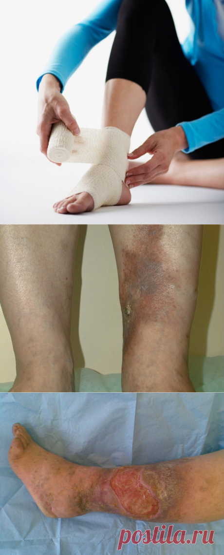 МКБ-10. Трофическая язва [причины и симптомы] Осложнения и Лечение