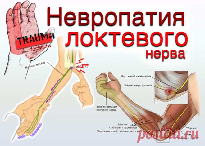 doclvs.ru | Невропатия локтевого нерва: причины, симптомы, диагностика, лечение
