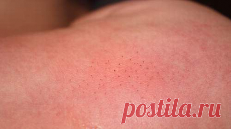 ЩЕТИНКА (КОЧЕРГА) У МАЛЕНЬКИХ ДЕТЕЙ. ЗАГОВОР