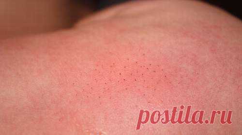 ЩЕТИНКА (КОЧЕРГА) У МАЛЕНЬКИХ ДЕТЕЙ. ЗАГОВОР