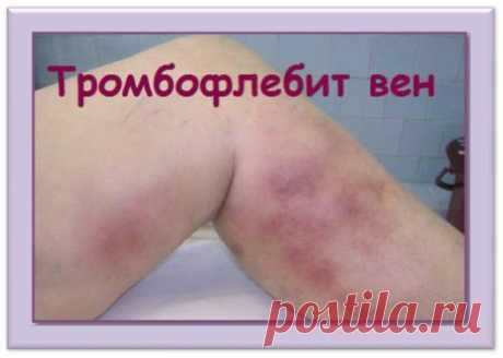 Сборы трав при тромбофлебите 

Тромбофлебит – очень серьезное заболевание, а тромбофлебит глубоких вен особо опасен, да и часто развивается он незаметно. Опасен тромбофлебит глубоких вен тем, что в результате физической нагрузки …