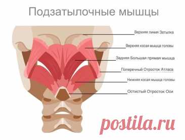 Боль в затылке. Триггерные точки