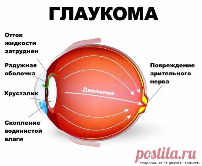 Лечение глаукомы народными средствами