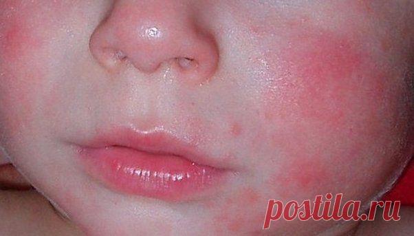 Атопический дерматит у грудничка: фото, лечение