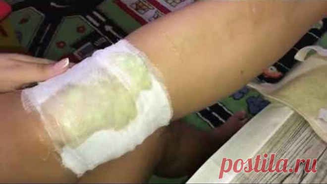ЭТА МАЗЬ вытянет всю БОЛЬ из колен и суставов!!! ЭТА МАЗЬ вытянет всю БОЛЬ из колен и суставов!!! 

ыстро снимет боль, воспаление в колене и суставах 

Видео имеет ознакомительный характер 

консультируйтесь с доктором!




РЕЦЕПТ-1 Л МЕДА СОЛИ И МАСЛО КРАПИВЫ ИЛИ СВЕЖЕЙ КРАПИВЫ И КАПУСТЫ.

#суставы #народные #советы #сустав #мазь #лечение #артроз #колено #боль #спина #коленный #артрит #болят #колени #чем #лечить #что #делать