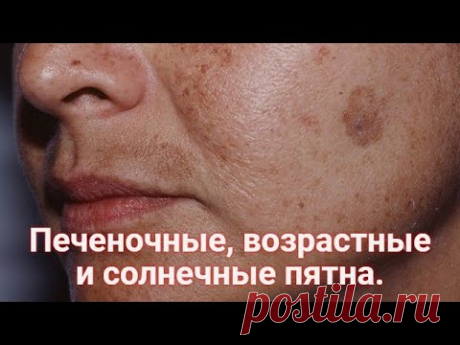 ПЕЧЕНОЧНЫЕ и ВОЗРАСТНЫЕ пятна, СОЛНЕЧНАЯ пигментация. Как убрать пигментные пятна с кожи? Рецепт.