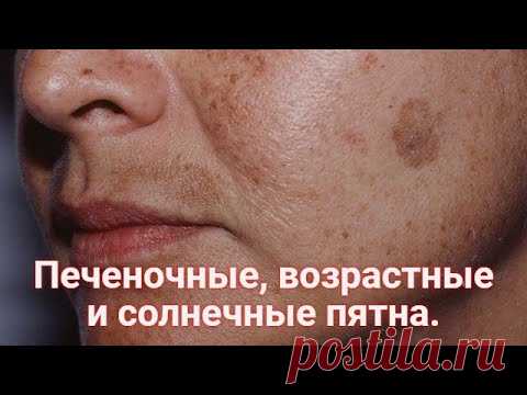 ПЕЧЕНОЧНЫЕ и ВОЗРАСТНЫЕ пятна, СОЛНЕЧНАЯ пигментация. Как убрать пигментные пятна с кожи? Рецепт.