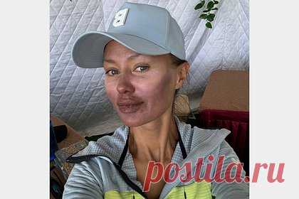 Виктория Боня показала крупным планом обгоревшее лицо с герпесом на губах
