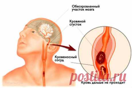 Инсульт: запомните 3 простых шага, чтобы спасти жизнь себе или близким
Во время отдыха на природе, молодая девушка вдруг резко остановилась и свалилась на землю. Отдыхающие хотели оказать помощь, но она удостоверила абсолютно всех, что чувствует себя прекрасно, просто споткнулась о камень в новых туфлях.   Девушка была очень блеклой и измотанной, ее отряхнули от песка и дали тарелку с пищей. Оставшийся день Инга провела без […]
Читай пост далее на сайте. Жми ⏫ссылку выше