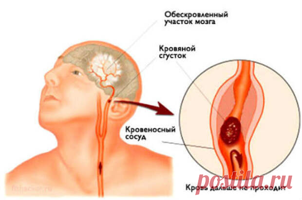 Инсульт: запомните 3 простых шага, чтобы спасти жизнь себе или близким
Во время отдыха на природе, молодая девушка вдруг резко остановилась и свалилась на землю. Отдыхающие хотели оказать помощь, но она удостоверила абсолютно всех, что чувствует себя прекрасно, просто споткнулась о камень в новых туфлях.   Девушка была очень блеклой и измотанной, ее отряхнули от песка и дали тарелку с пищей. Оставшийся день Инга провела без […]
Читай пост далее на сайте. Жми ⏫ссылку выше