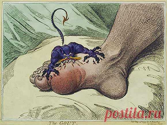 Подагра-болезнь королей или гениев?