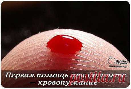 Первая помощь при инсульте - кровопускание!.