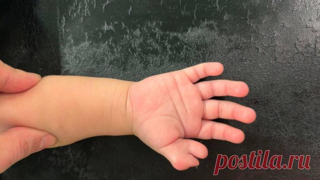 Подмосковные врачи избавили трехлетнего пациента от лишнего пальца на руке. В Подмосковье прооперировали трехлетнего пациента с шестью пальцами на руке. Об этом сообщает Telegram-канал "Разборчивым почерком". Родители вместе со своим сыном обратились за помощью в больницу. Причиной стала врожденная ...