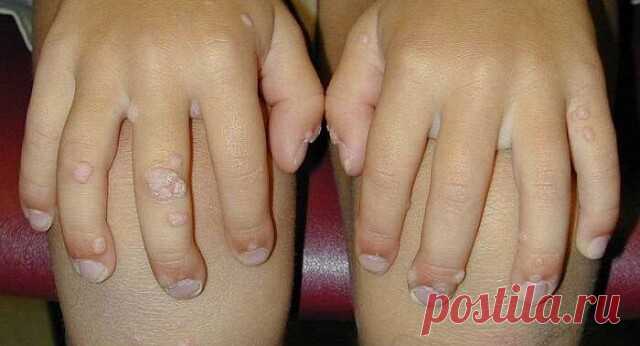 РИТУАЛ ОТ КОЖНЫХ ЗАБОЛЕВАНИЙ 
 
Если болячки по телу пойдут (язвы, нарывы, угри, прыщи, лишай и пр.), надо взять из церкви освященной воды, дать больному попить с ложки, обмывать больные места и говорить: 
 
Святая вода, очисти тело рабы Божьей (имярек), чтобы было так же чисто и свято, как святая вода. 
 
Три раза так сказать, а воду, оставшуюся после мытья, вылить туда, где люди не ходят. Сделать это надо после захода солнца. 
 
От бородавок и прыщей 
*******************...