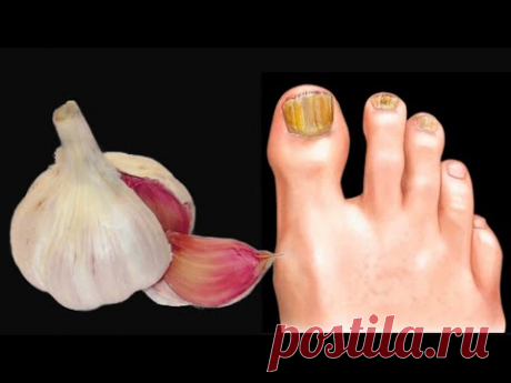 Мгновенно удаляет грибок ногтей, как ластик!
Ингредиенты:
1 чеснок
Сок половины лимона
2 стакана воды
1 столовая ложка водки
1 столовая ложка разрыхлителя
1 столовая ложка морской соли
1 столовая ложка оливкового масла