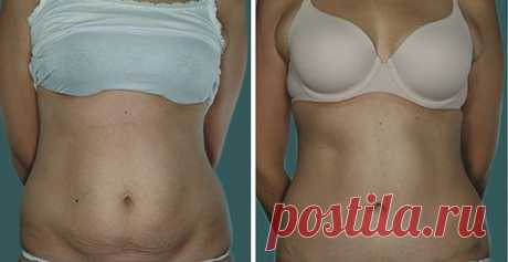 Мой опыт избавления от жира на животе за 30 дней. Упражнения + домашнее жиросжигающее обёртывание! | Подслушано у диетолога | Яндекс Дзен