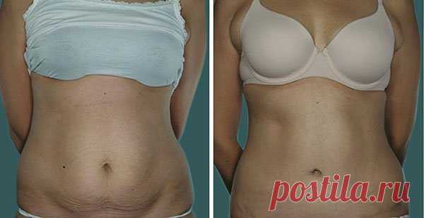 Мой опыт избавления от жира на животе за 30 дней. Упражнения + домашнее жиросжигающее обёртывание! | Подслушано у диетолога | Яндекс Дзен